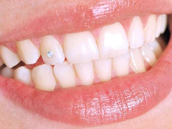 tooth jewel